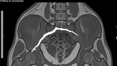 Fratura do colo femoral por estresse