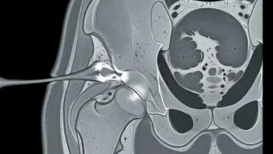 Lesão nos ligamentos do quadril