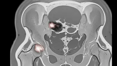 Descompressão do núcleo da necrose femoral