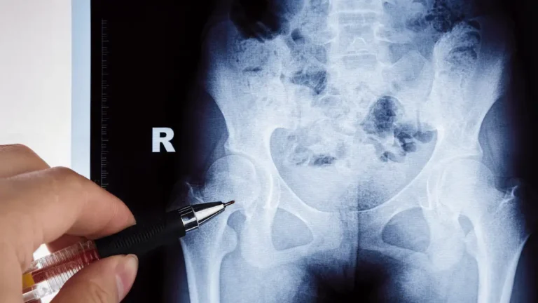 Tumor no quadril tem cura