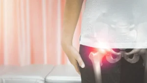 Osteonecrose da cabeça do fêmur