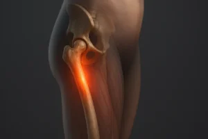 Tumor no fêmur tem cura