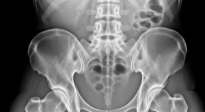 Necrose avascular do quadril